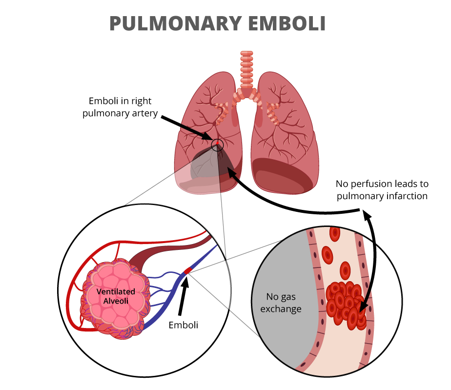 Graphic of a pulmonary emboli